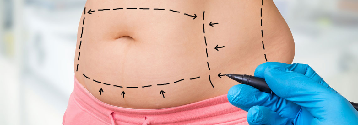 Abdominoplastie